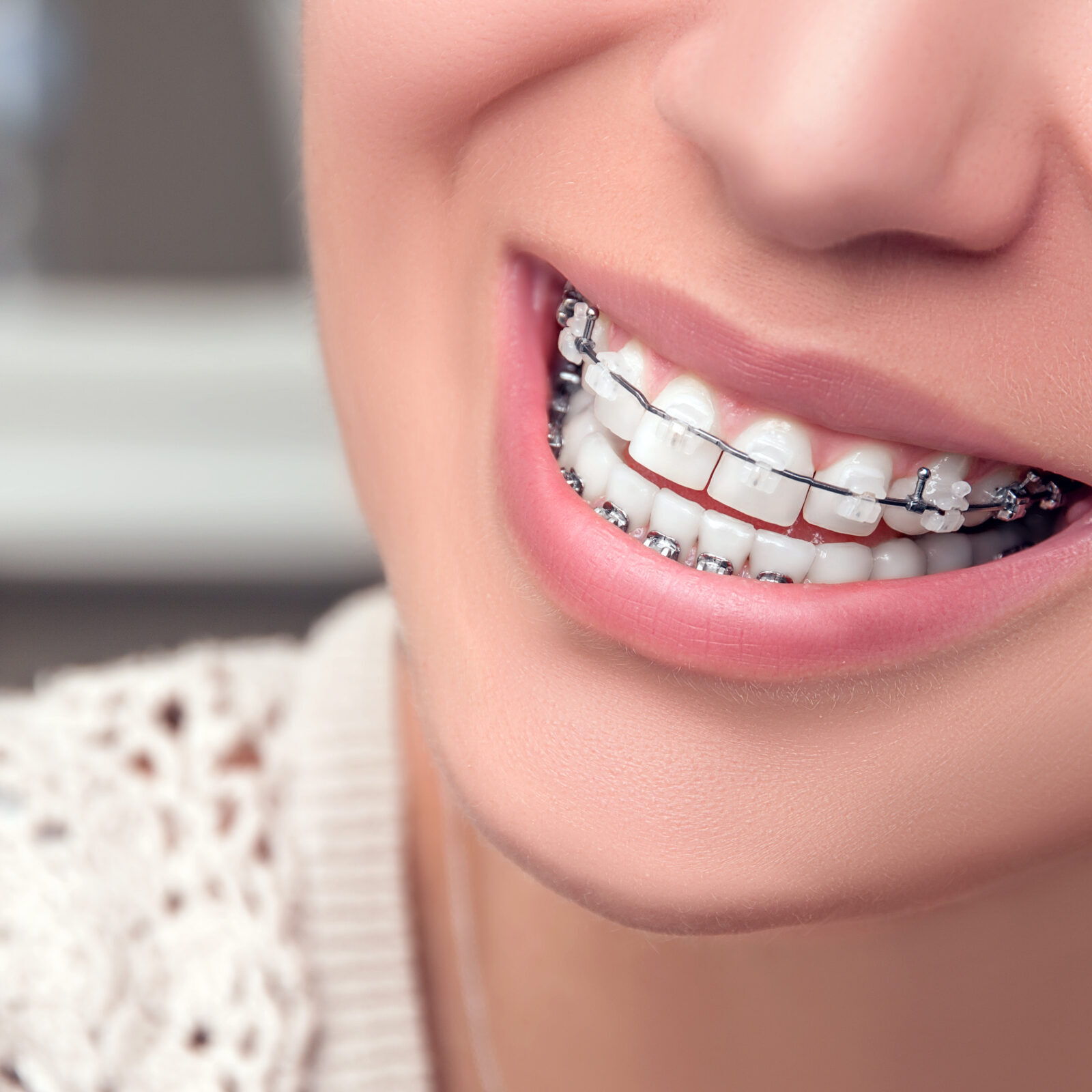 Braces.,Orthodontic,Treatment.,Dental,Care,Concept.,Beautiful,Woman,Healthy,Smile bountiful orthodontics